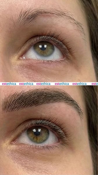 See why patients choose us for the best hair transplant in Istanbul