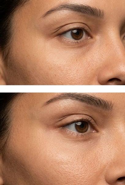 It’s been a few months since my procedure, and the effect is still as amazing as day one. The upward lift gives my face such a modern, 'snatched' look. Every time I look in the mirror, I’m so glad I did it. I highly recommend this to anyone wanting that cat-eye look!