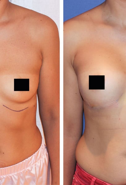 Ho finalmente trovato il posto giusto per il mio aumento del seno a Istanbul. I risultati sembrano e si sentono incredibilmente naturali, esattamente ciò che speravo!