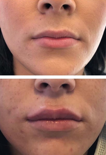 This was my first time getting fillers, and I was very nervous. The team walked me through every step. They listened to exactly what I wanted and didn't overdo it. If you want subtle yet effective results, this is the place.