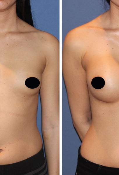 Am fost îngrijorat de recuperare, dar tehnica cu cicatrici minime pe care au folosit-o a dat rezultate extraordinare. M-am întors la rutina mea zilnică mult mai repede decât mă așteptam!