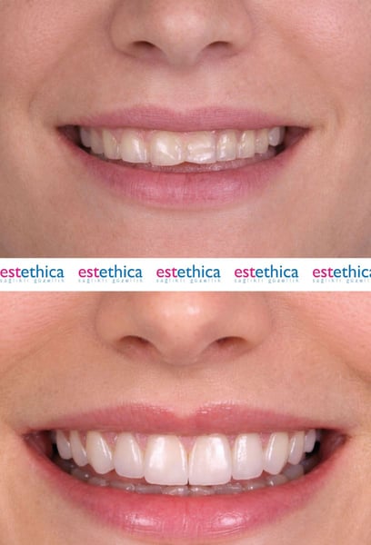 I chose them for my hair transplant in Istanbul  and it was the best decision I made.