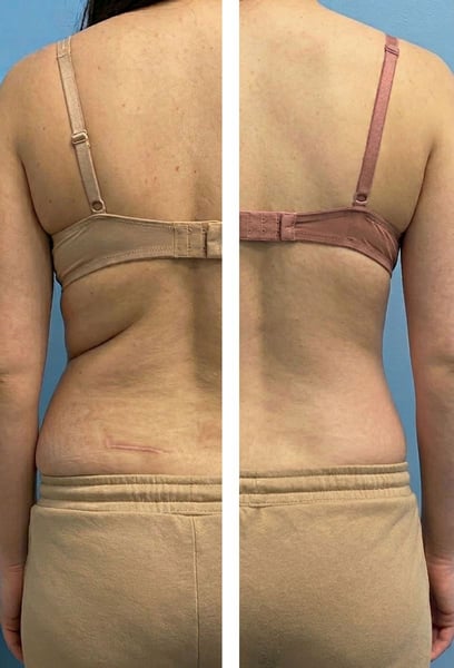 Удивителни резултати! Загубих 6 см от талията си само за 4 сесии. Процедурата беше безболезнена, а кожата ми се чувства много по-стегната. Накрая се отървах от онези упорити зони, които упражненията не можеха да оправят. Препоръчвам горещо!