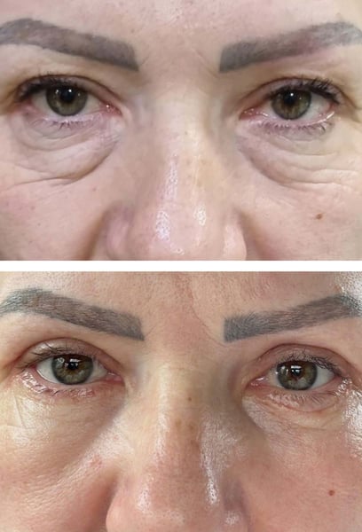 I used to look tired even after a full night's sleep because of my hooded eyelids. Since the surgery, my eyes look open, bright, and refreshed. People keep telling me I look 10 years younger! It’s the best investment I’ve made for myself.
