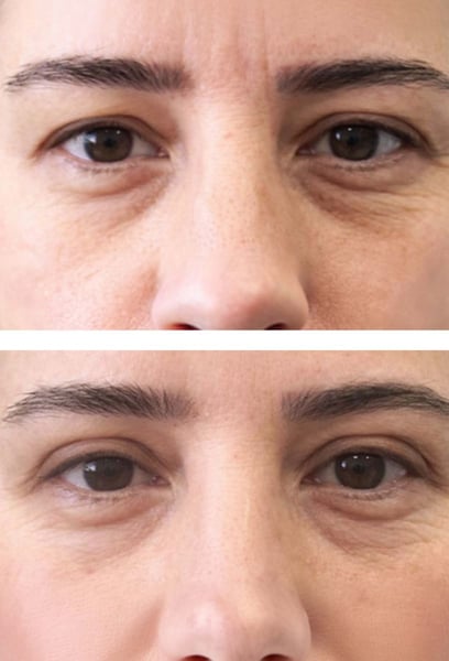 I used to hate how my eye makeup would disappear into my eyelid folds. Now, applying makeup is a joy, and I feel confident looking at myself in the mirror. It’s a small change that made a massive difference in my self-esteem.