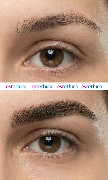 See why patients choose us for the best hair transplant in Istanbul