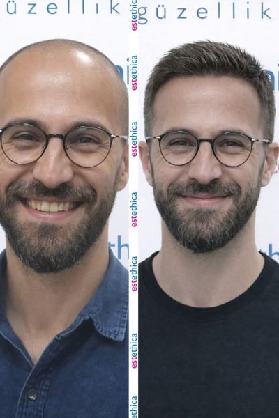 See why patients choose us for the best hair transplant in Istanbul