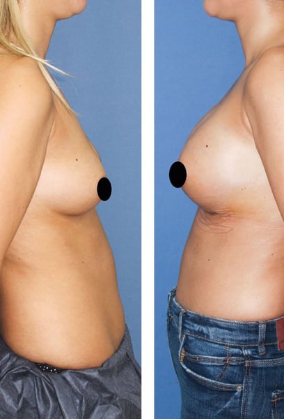 Dopo aver ricercato ovunque, li ho scelti per il mio intervento chirurgico. È stata la migliore decisione che abbia mai preso per la mia autostima e l'immagine del mio corpo.