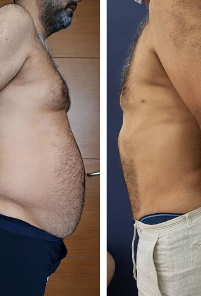 Ero esitante riguardo all'intervento chirurgico addominale come uomo, ma i risultati parlano da soli. Il chirurgo ha rimosso la pelle ostinata e ha rassodato i miei muscoli addominali, offrendomi un profilo molto più maschile e in forma. La ripresa è stata fluida e la cicatrice è molto ben nascosta. Se sei un uomo che sta pensando a questo, non esitare: questa clinica è la migliore.