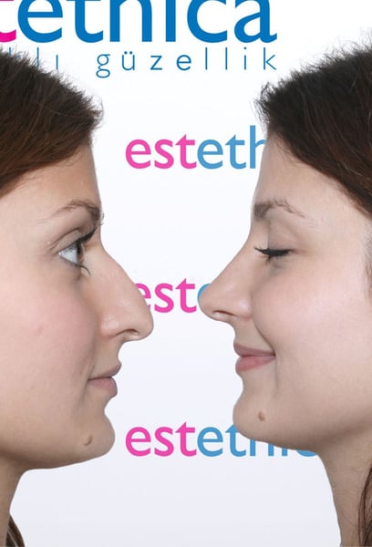 After researching everywhere, I chose them for my hair transplant in Istanbul