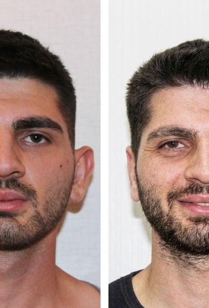 My biggest fear was that my ears would look 'pinned back' or unnatural. However, the surgeon gave them such a perfect angle that nobody can even tell I had surgery. My face just looks more balanced now. I am incredibly happy with the result.