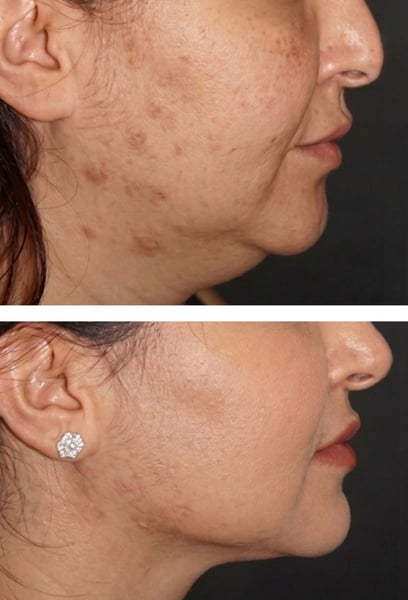 I used to wear scarves and high-neck tops even in summer just to hide my chin area. Submental Liposuction literally lifted a weight off my shoulders. I feel lighter, more confident, and comfortable in my own skin. It is the best investment I have ever made for my self-esteem.