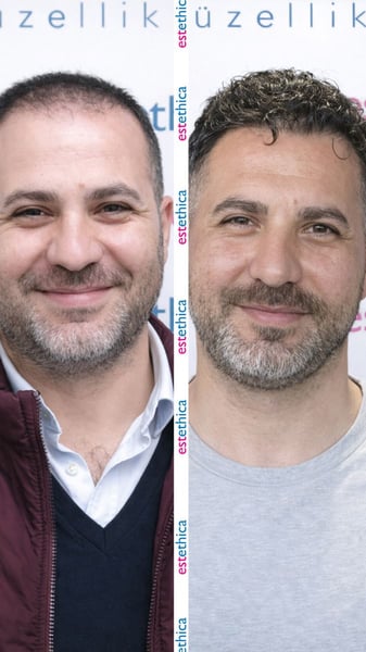 See why patients choose us for the best hair transplant in Istanbul