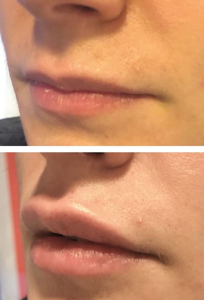 I’ve always been self-conscious about my thin upper lip, but I was terrified of looking like a 'duck.' The results here are so natural! My lips look hydrated, plump, and perfectly shaped. I finally have the smile I’ve always dreamed of.