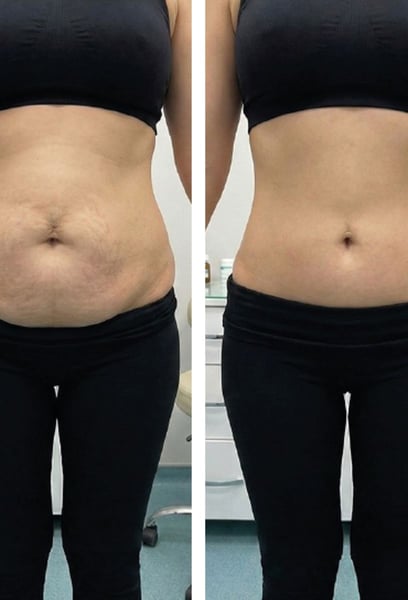 От първоначалната консултация до крайния резултат, грижата беше изключителна. Специалистите точно разбраха какво е необходимо на тялото на майката и създадоха план, който перфектно отговаряше на моите цели.