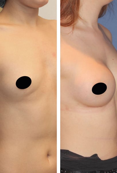 Călătoria la Istanbul pentru procedura mea a fost cea mai bună alegere. De la prima consultație până la controlul final, m-am simțit în siguranță și bine îngrijit.