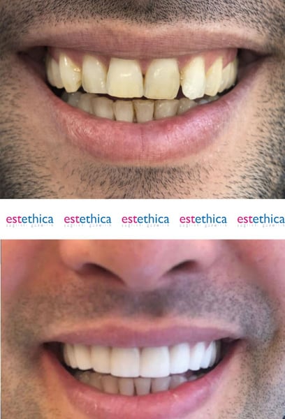 I didn’t want to take risks  that’s why I had my hair transplant here in Istanbul