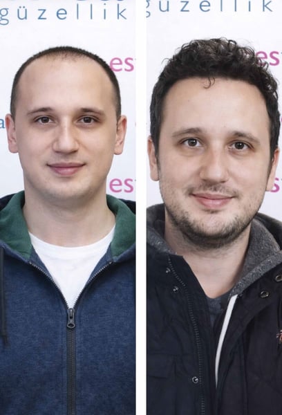 Не исках да поемам рискове, затова направих трансплантация на коса тук в Истанбул.