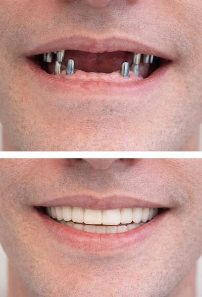 Perdere un dente ha davvero influito sulla mia autostima. Grazie a questa clinica, ho riavuto il mio sorriso. La qualità dell'impianto è eccezionale e la vestibilità è perfetta. La migliore decisione di sempre.