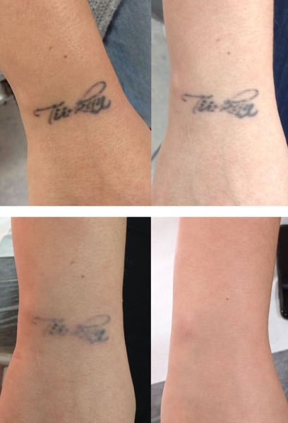 Премахването на татуировка е като да си върнеш част от миналото. Имах име на китката си, за което съжалявах години наред. Процесът на премахване напълно промени живота ми и самочувствието ми. Накрая мога да нося къси ръкави, без да се чувствам неуверена.