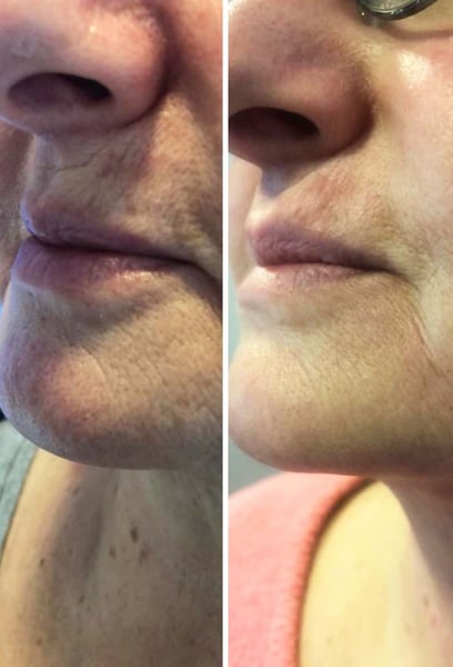 Super quick procedure with no bruising. I look years younger and much less tired. If you're on the fence, just do it—it’s worth every penny!