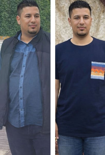 What impressed me most was the post-op support. The hospital’s dietitians helped me adapt to my new lifestyle seamlessly. I never felt alone during my transformation journey.