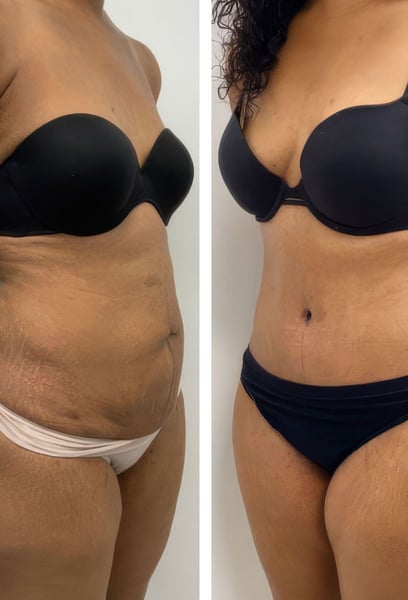 Комбинирането на корекция на корема с повдигане на гърдите беше най-доброто решение. Възстановяването беше добре управлявано, а да видя как цялото ми тяло се трансформира наведнъж беше наистина променящо живота. Горещо препоръчвам тяхната експертиза.