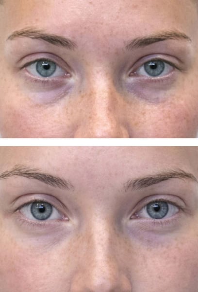 I was worried about looking 'surprised' or unnatural, but the results are incredibly subtle and perfect. My heavy eyelids are gone, and my natural eye shape is enhanced. The scarring is completely invisible. I couldn't be happier.