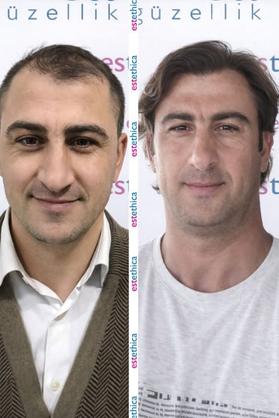 See why patients choose us for the best hair transplant in Istanbul