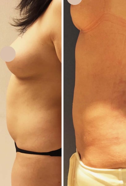 Questa procedura è stata la spinta di cui avevo bisogno per uno stile di vita più sano. Vedere il mio nuovo corpo mi ha motivato a rimanere in forma e a mangiare bene. Mi sento più leggero, tonico e molto più energico.