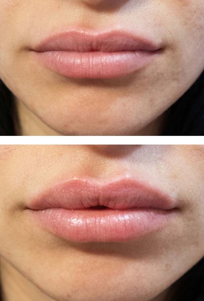 I didn't just want bigger lips; I wanted a better shape. The way they defined my Cupid's bow is pure art! My lips look sharp, elegant, and totally suit my face. I get compliments every single day.