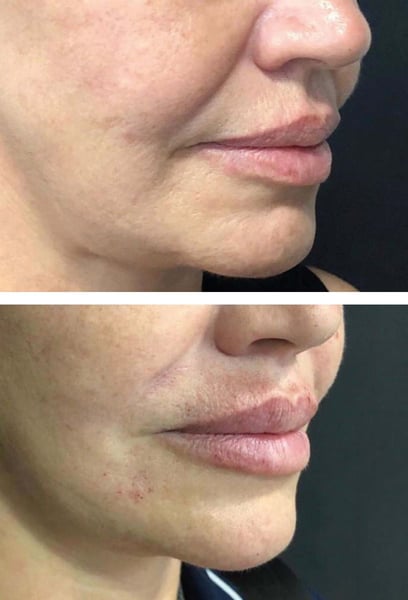 It’s amazing how a little bit of filler can change your entire mood. I feel so much more attractive and confident. The technique used was very precise, and the swelling went down in just a couple of days. Highly recommend!