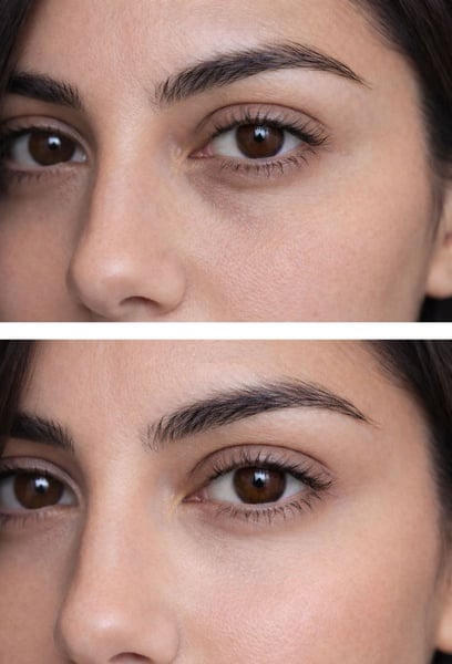 The shadows under my eyes used to make me look much older than I actually am. This filler literally 'lit up' my face. My skin looks smoother, and the sunken look is gone. I feel like I’ve turned back the clock five years. Highly recommend this clinic!