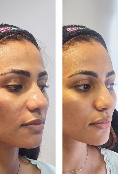 The results are incredible! My skin looks so much firmer and the hollow areas are gone. It’s the perfect ‘pick-me-up’ for anyone wanting a younger look without the surgery.