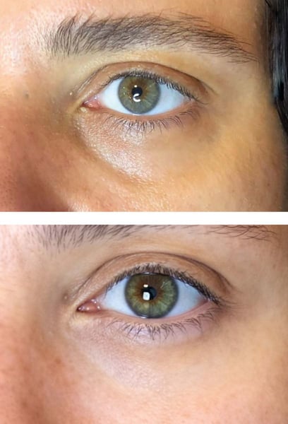 I was nervous about looking 'fake,' but the results are incredibly natural. People keep telling me I look well-rested, but they can't figure out why! The specialist's technique was perfect—no lumps, no swelling, just a smooth and youthful transition.