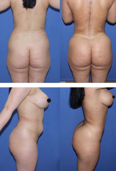 Преди избирах дрехи в зависимост от това, което исках да скрия, но сега всичко ми стои перфектно. Формите ми са точно такива, каквито си ги представях. Резултатите са просто безупречни!