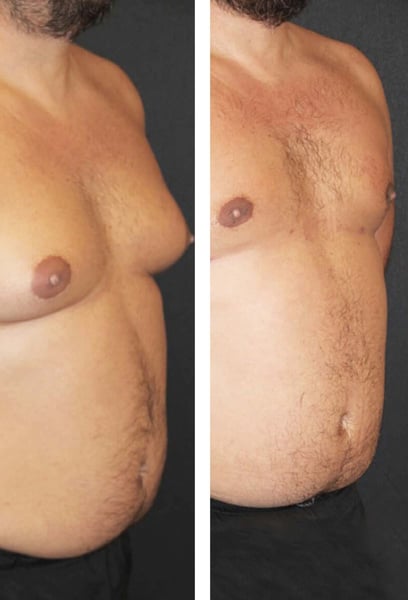 From the first consultation, the professionalism was outstanding. They tailored the surgery plan exactly to my needs. The result is exactly what I hoped for: a firm, flat chest. It feels like I’ve finally reclaimed my body.