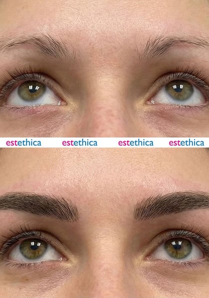 See why patients choose us for the best hair transplant in Istanbul