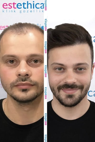 See why patients choose us for the best hair transplant in Istanbul