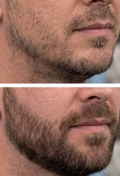 They didn't just plant hair; they designed a beard that fits my face shape perfectly. It looks like I was born with it. Highly recommend this clinic.
