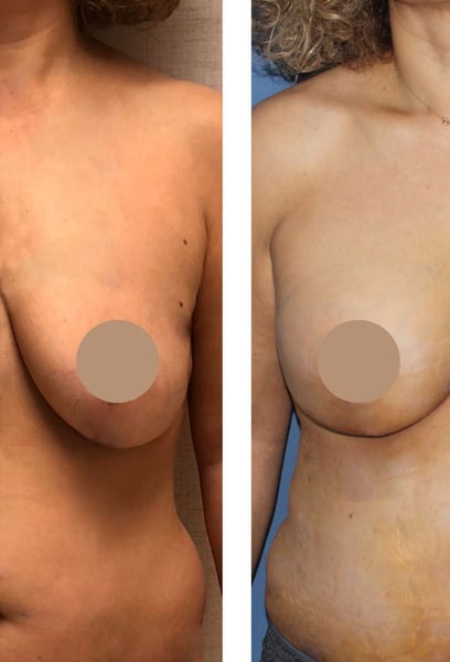 I feel ten years younger! The sagging is gone, and the positioning is perfect. I wish I had done this sooner. Thank you to the entire hospital team.