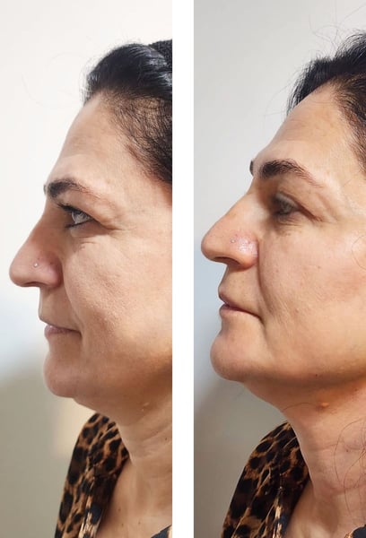 I was terrified of surgery, so this was the perfect alternative. It lifted my sagging skin without the scars or the scary price tag. I’m obsessed with the results!