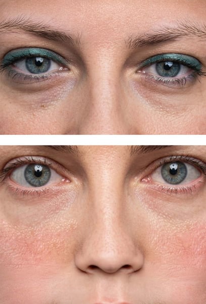 The hygiene standards and the professionalism at this hospital are top-notch. They explained the entire process of the Light Filler clearly, which put me at ease. The results are exactly what I hoped for—my gaze looks much more vibrant and energetic now.