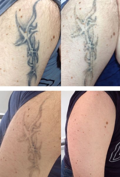 Най-голямият ми страх беше увреждане на кожата или постоянни белези. Много съм щастлив, че избрах тази клиника. Специалистите са много внимателни и професионални; те настройват параметрите перфектно за типа ми кожа. Татуировката ми изчезна, а кожата ми все още изглежда здрава и гладка.