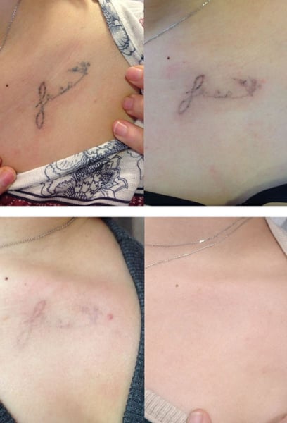 Екипът се грижи да се чувствате удобно през цялата процедура. Те обясняват следоперативната грижа толкова ясно, което ми помогна да се възстановя бързо между сесиите. Напредвам наполовина в лечението и резултатите са невероятни. Препоръчвам горещо на всеки, който иска ново начало.