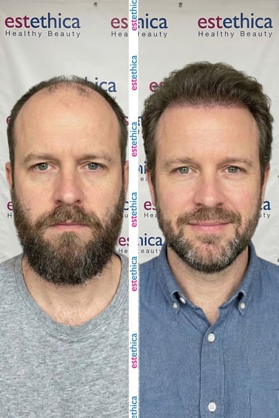 See why patients choose us for the best hair transplant in Istanbul