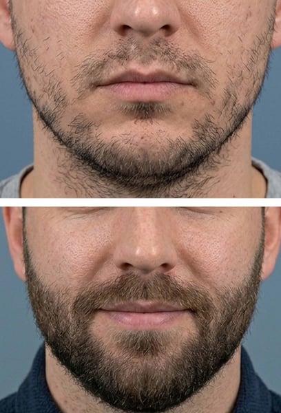 The new beard shape has completely redefined my jawline. I feel much more masculine and confident. Best decision I’ve ever made for my appearance.