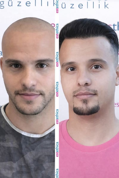 See why patients choose us for the best hair transplant in Istanbul