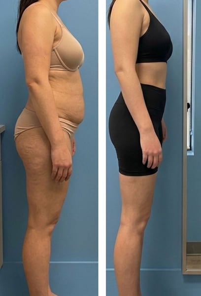 Дойдох специално за целулита на краката си. Не само че краката ми станаха по-слаби, но и 'портокаловата кора' почти напълно изчезна. Кожата ми изглежда толкова гладка и стегната. Всъщност с нетърпение очаквам сезона на банските тази година!