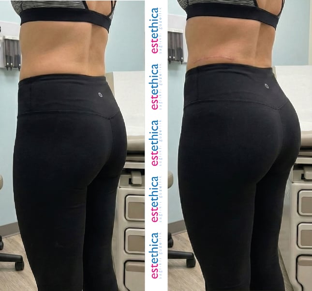 See why patients choose us for the best hair transplant in Istanbul